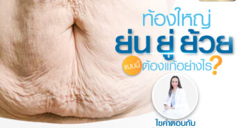 ท้องย้วย ย่น ยู้